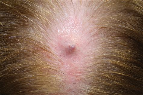 Sudden painful lump on back of head - xasermates