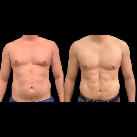 liposuction hips