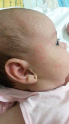 Bebe Cheio De Carocinhos No Corpo - Carocinhos no corpo, rosto e cabeça tipo espinha | BabyCenter