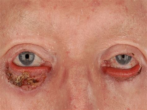 Pityriasis Rubra Pilaris Pathology