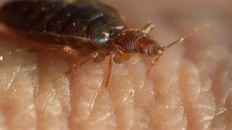 Bedbug Sitting on Human Skin Stock Video - Video of disease, bedbug ...