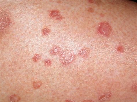 Diabetes Itchy Rash Treatment at Kelli Johnson blog