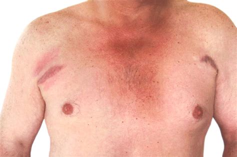Scar Camouflage Treatment – Abate MediSpa Sanctuary