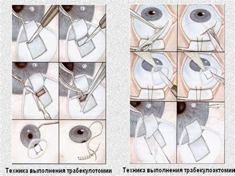 Глаукома. Внутриглазное давление - презентация онлайн