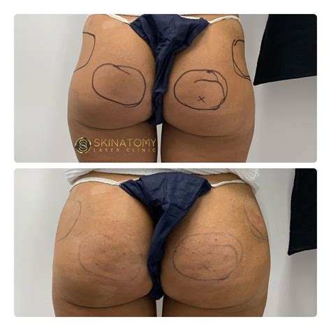 Sculptra® Butt Lift Toronto | Non-Surgical BBL Mississauga | Skinatomy