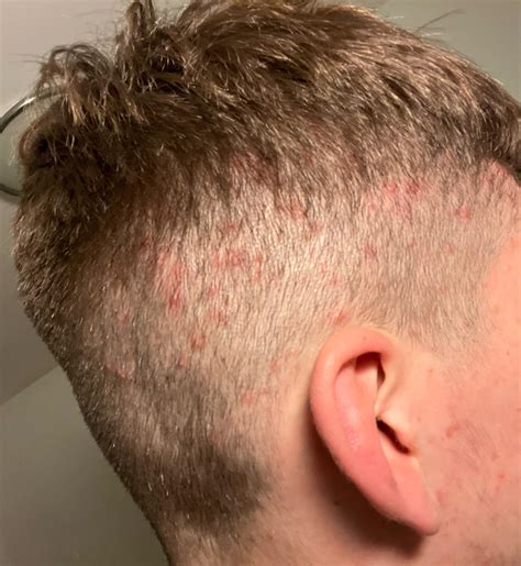What is this??? Folliculitis? Ingrowns? Scabs? Infected? : r/Folliculitis