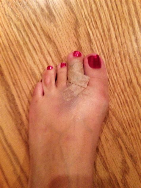 My Toe Shortening Surgery Experience