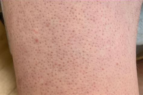 keratosis pilaris healthify