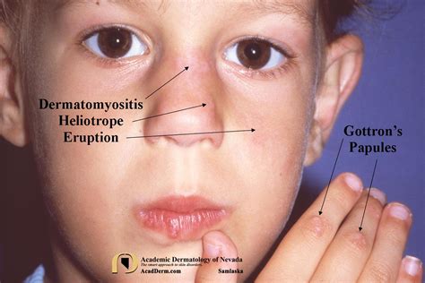 Dermatomyositis - Academic Dermatology of Nevada