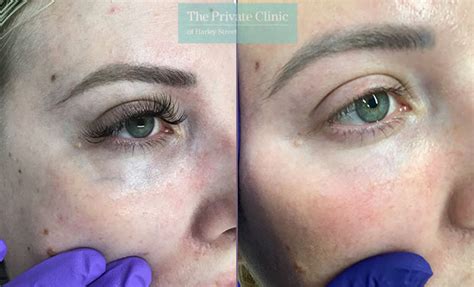 Under Eye Veins 005MN side - The Private Clinic of Harley Street London