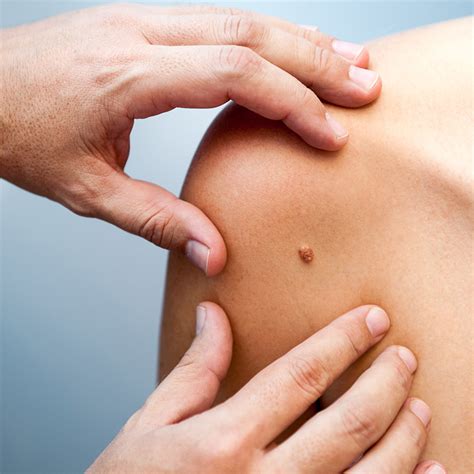 skin cancer skin physicians dermatology