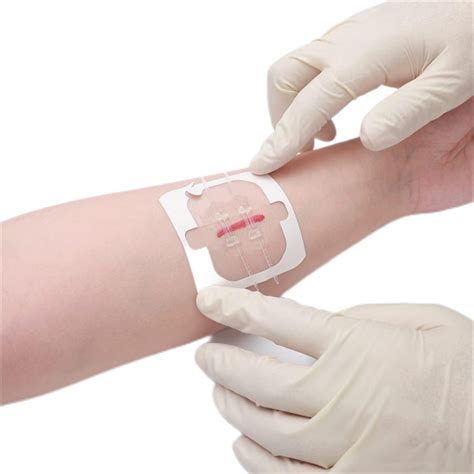 china customized emergency laceration closure efficient emergency