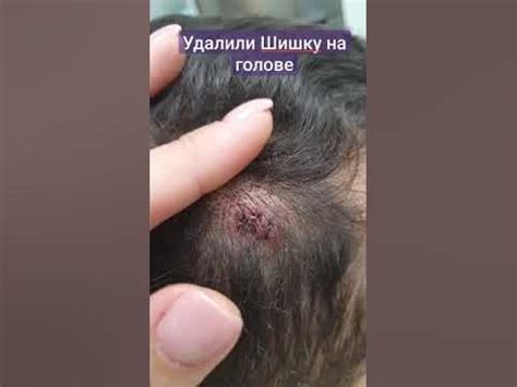 Удалили жировик ( липома ) шишку на голове - YouTube