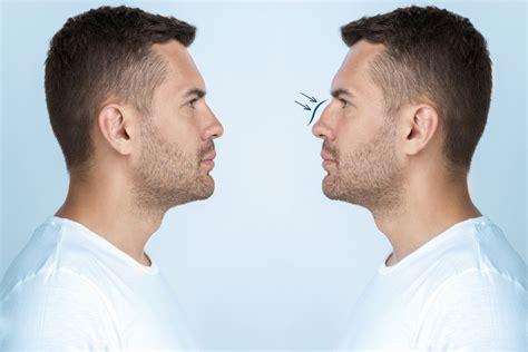 What You Should Know About Rhinoplasty Swelling Stages?