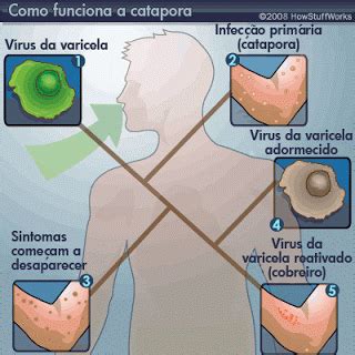 Como É Transmitido A Catapora - Aprenda sobre a Catapora
