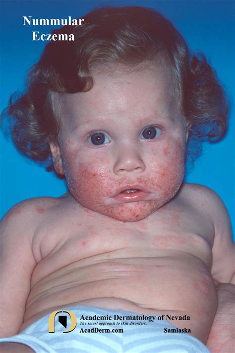 nummular eczema academic dermatology  nevada