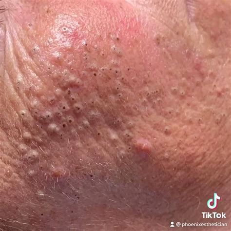 Unbelievable Blackhead Removal 2024: Before & After Photos Will Blow Your Mind! - 1j4ohy8