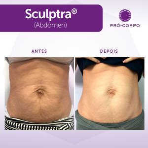 Sculptra Antes E Depois Barriga