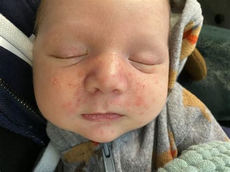 Currently breastfeeding my 4 week old. Wondering if baby acne like this