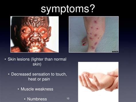 PPT - Leprosy PowerPoint Presentation - ID:3060390