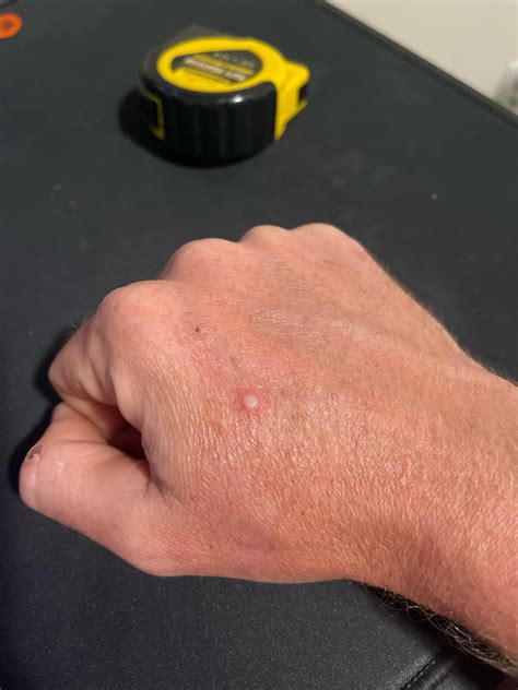What do you think this is? Wart? : r/Warts
