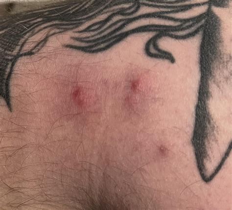 Are these Brown Recluse bites? : r/BrownRecluseBites