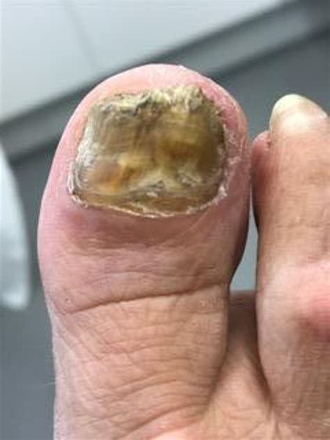 Lunula Laser | Podiatry, Chiropody, Specialist Shoes and Mobility