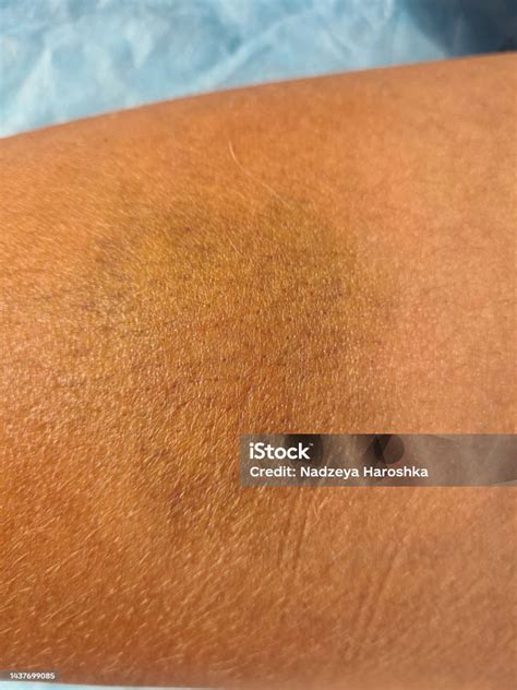 Closeup Bruise On Skin Of Person Is Blue Yellow In Color Stock Photo ...
