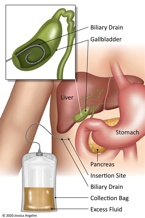Biliary Drain | OncoLink