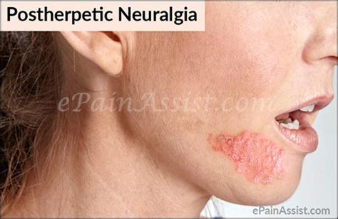 postherpetic neuralgia courtney medical group vrogueco
