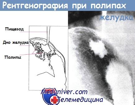 Полипы желудка - диагностика