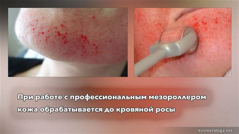 Мезороллер - в чём подвох?