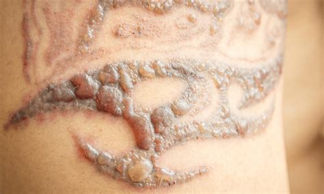 What Are The Risks And Side Effects of Laser Tattoo Removal? - VIVA ...