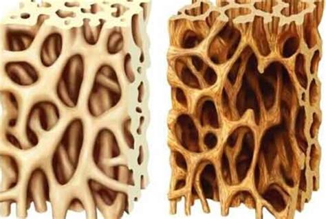 Osteoporosi e Osteopenia - Trattamento e cura preventiva