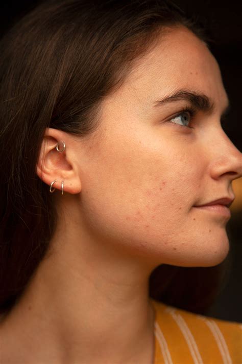 Hormonal Acne Neck