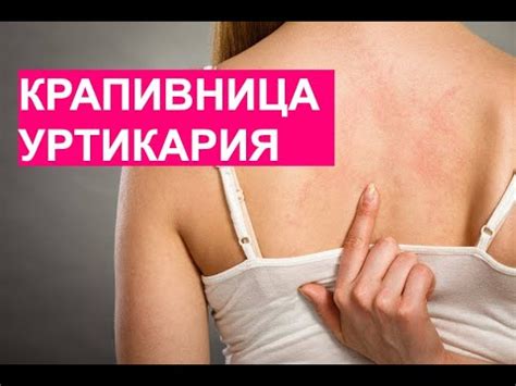 Крапивница, Уртикария - быстрое и простое лечение - YouTube