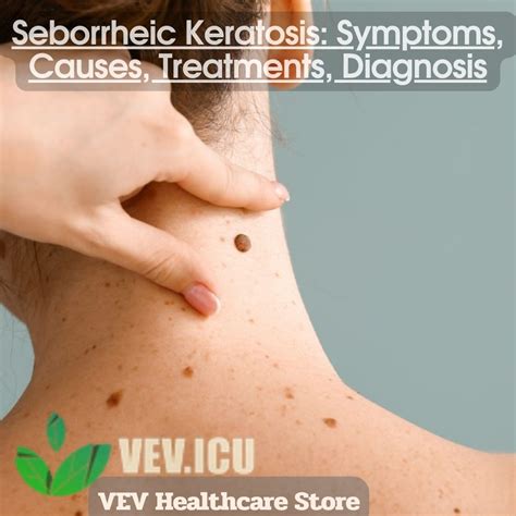 Seborrheic Keratosis: Symptoms, Causes, Treatments, Diagnosis