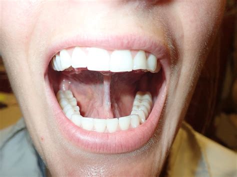 adult case study lingual frenectomy amw myofunctional therapy