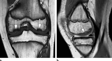 osteochondritis dissecans    imaging  coronal  weighted image