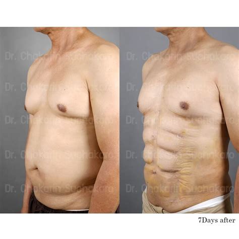 6 Pack Abs Plastic Surgery – Blogiwi.com