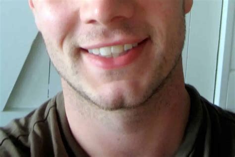 cleft chin in women 3