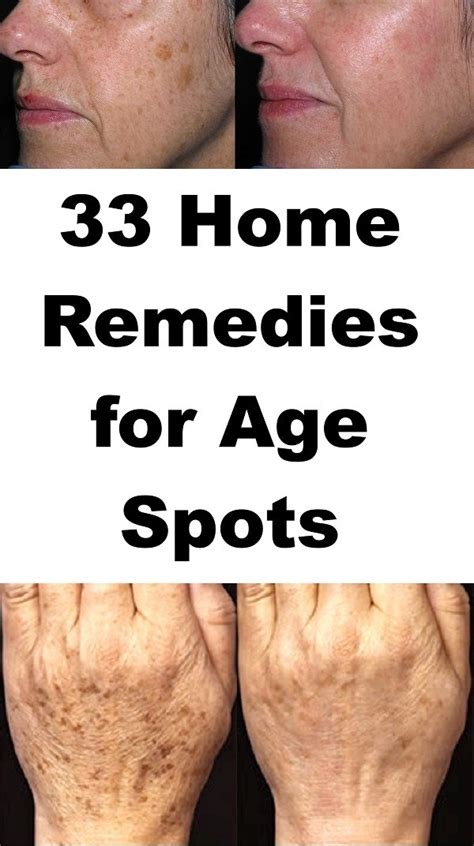 how to get rid of age spots on hands