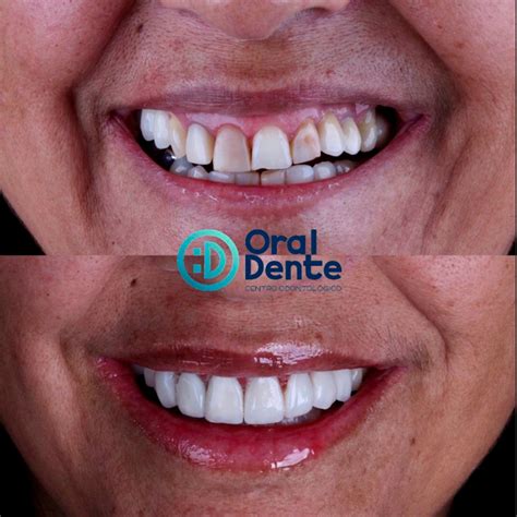 Faceta De Resina Antes E Depois - Antes e depois de facetas em resina – Oral Dente