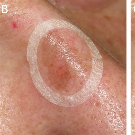 Examples of lentigo maligna melanoma (case 2, panels A-C) and lentigo... | Download Scientific ...