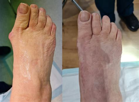 Lapidus + Akin Osteotomy | Foot & Podiatry Surgery