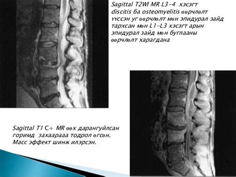 Багана нурууны халдварт эмгэгүүд сүүлийн