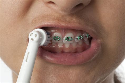 Can You Use an Electric Toothbrush with Braces? | Voss Dental - Oral ...