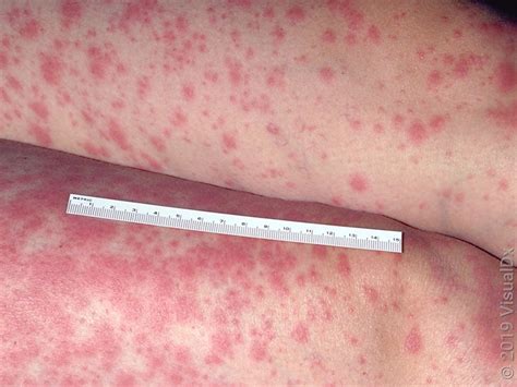 Stevens Johnson Syndrome Lamotrigine