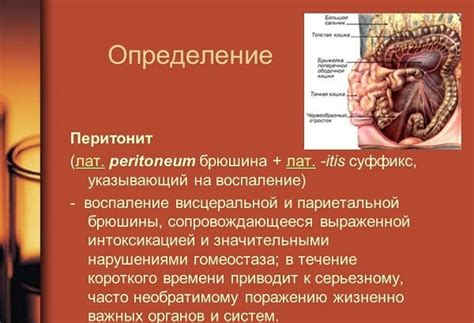 Перитонит: симптомы, виды, диагностика и методы лечения
