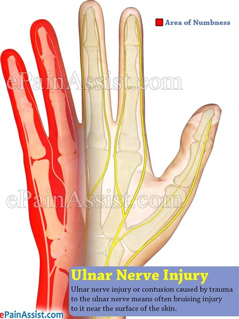 Ulnar Nerve Damage Symptoms